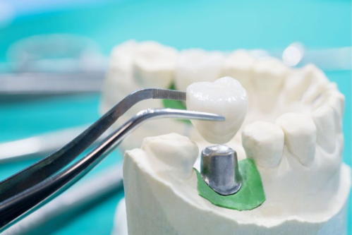 Serene Dental Center Dental Crowns